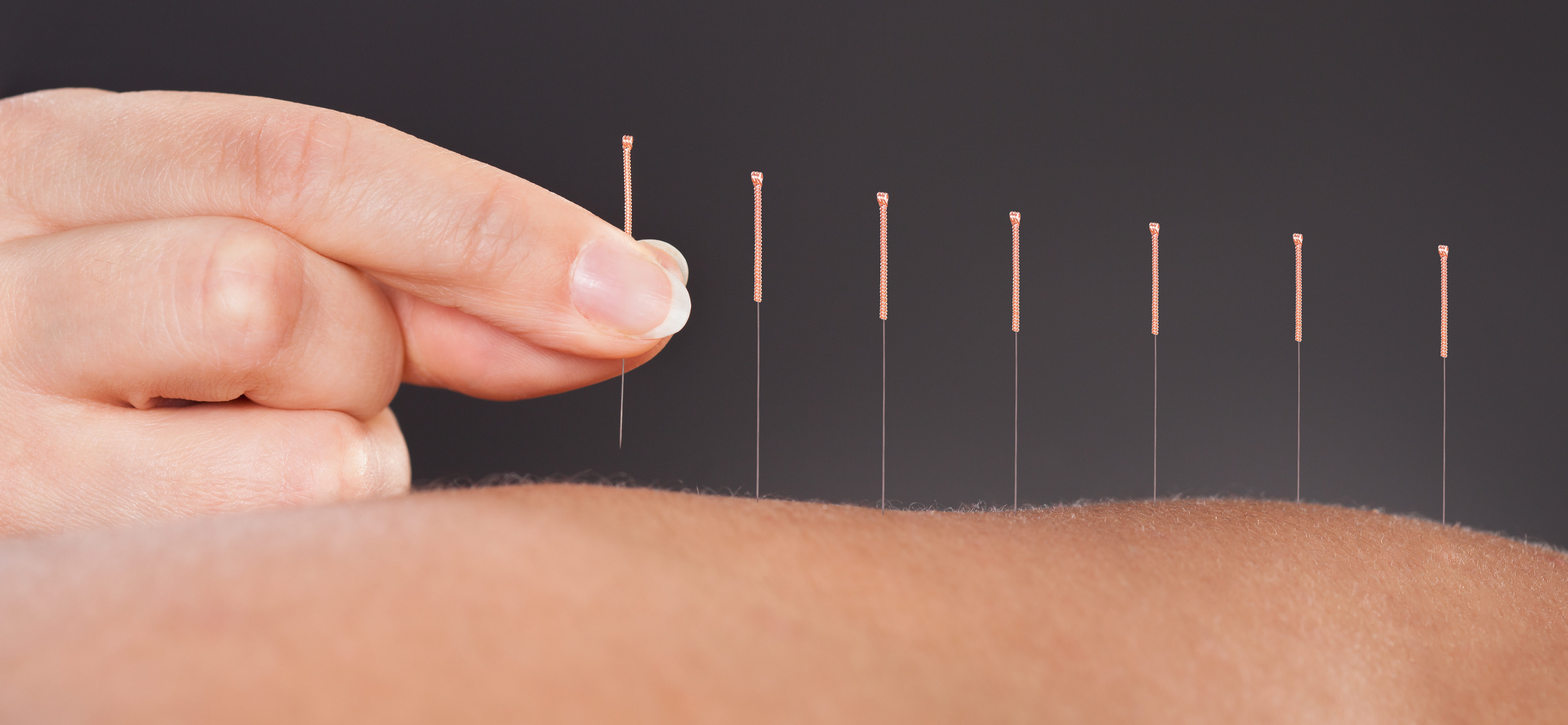 Acupuncture Treatment