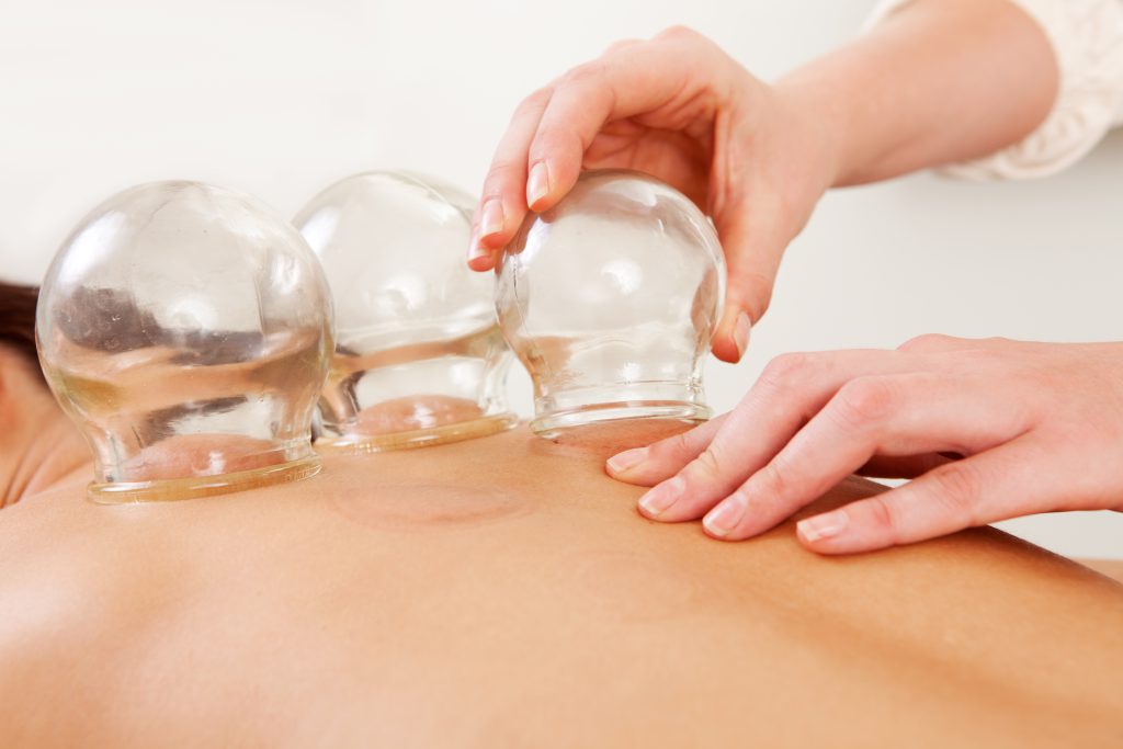 Picture of cupping therapy on someones back