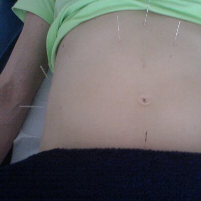 Central London Acupuncture