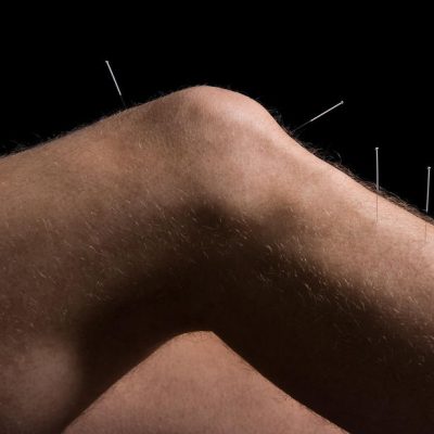 acupuncture-knee