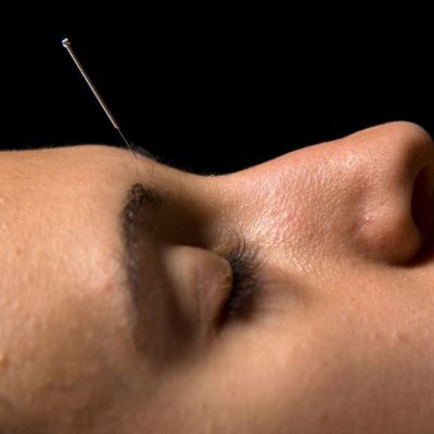 London Best Acupuncture