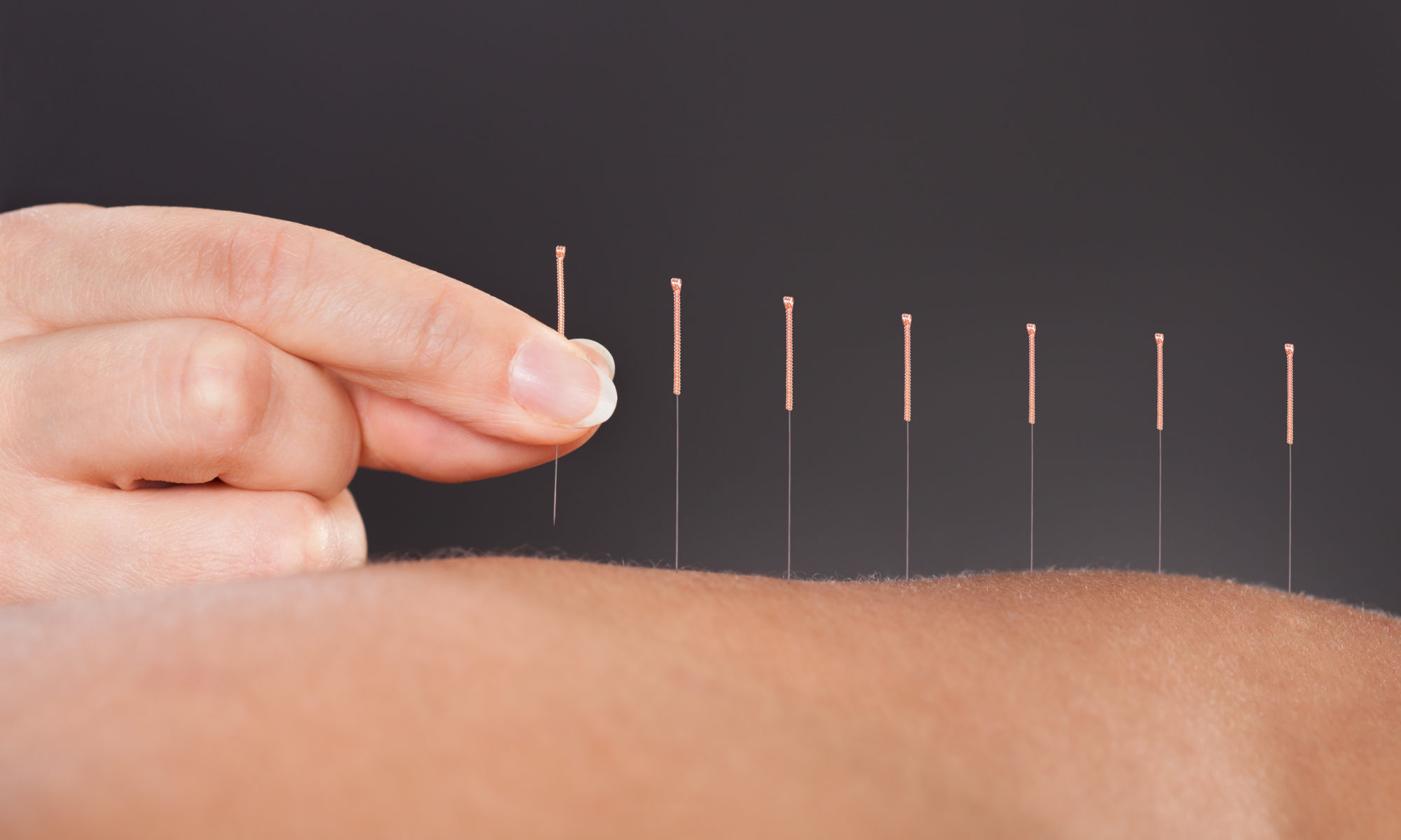 Acupuncture Treatment