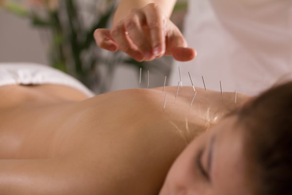 acupuncture-upper-back
