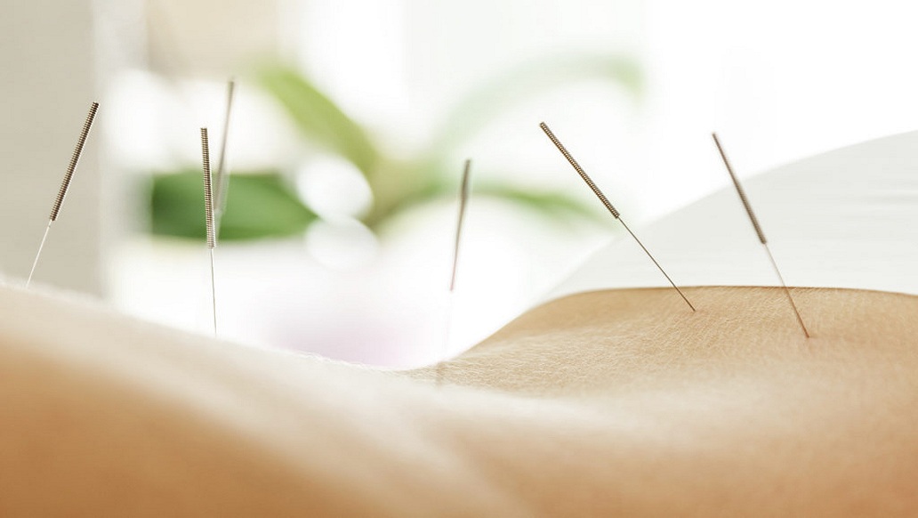 Acupuncture London