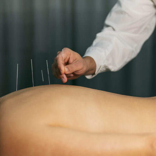How Acupuncture Can Alleviate Pain from Long Tube Rides