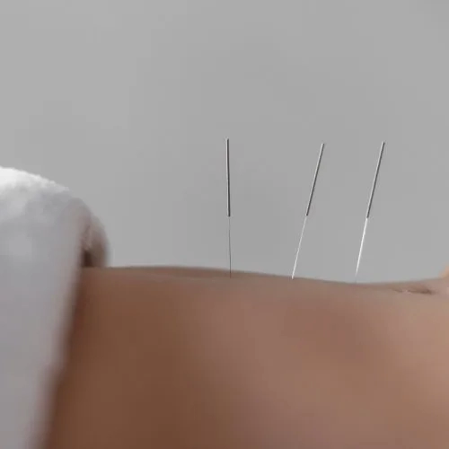Acupuncture London