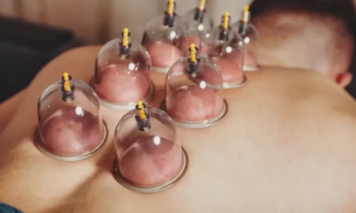 cupping image dry needling vs acupuncture blog