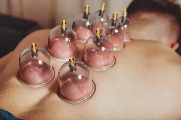 cupping image dry needling vs acupuncture blog