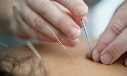 acupuncture treatment applied to muscles of the upper back