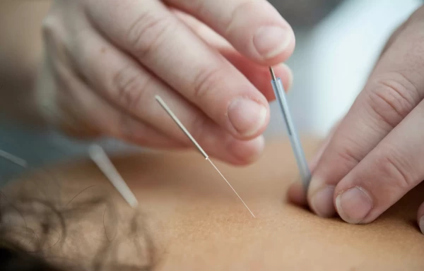 acupuncture treatment applied to muscles of the upper back