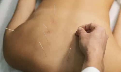 detox acupuncture in rehab programs