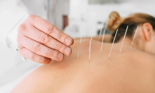 How many acupuncture sessions are needed for results