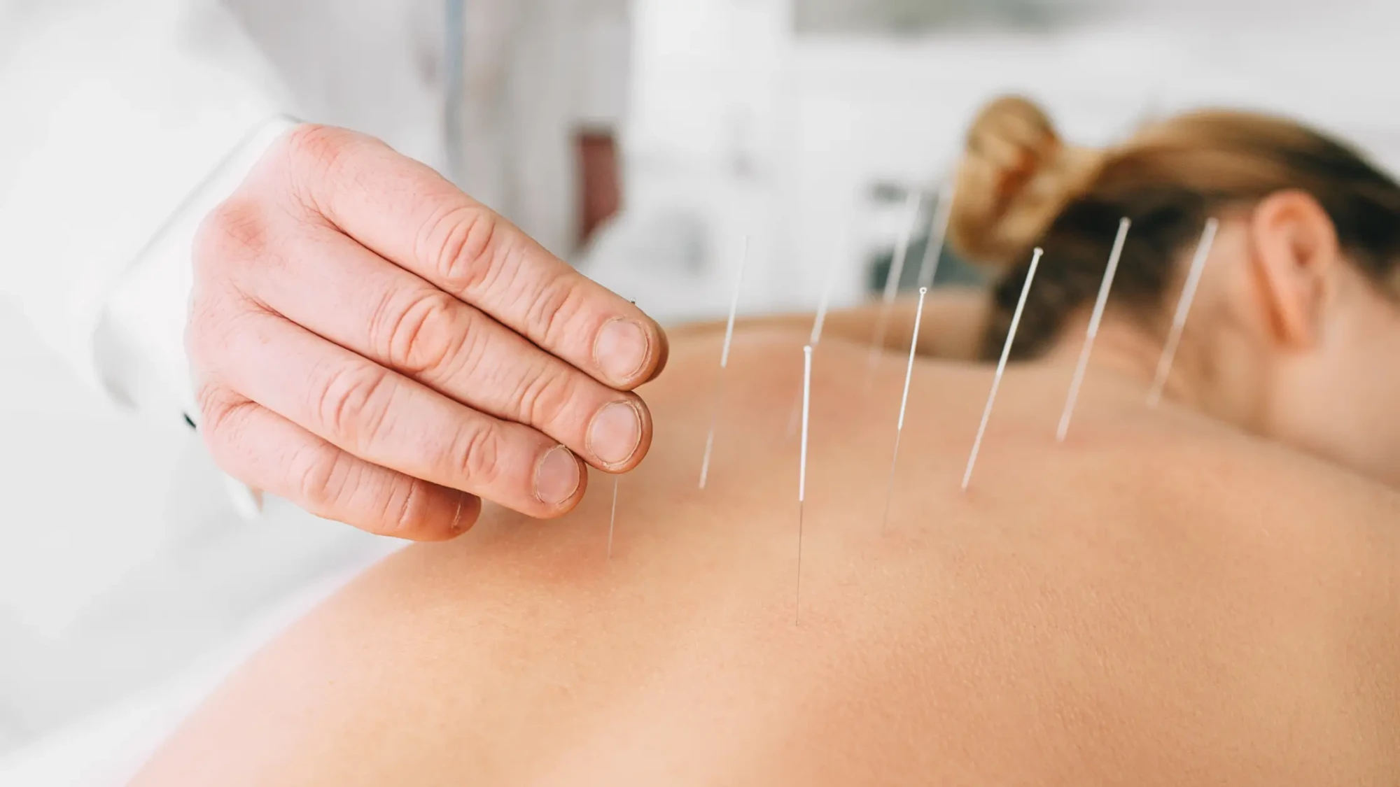 How many acupuncture sessions are needed for results